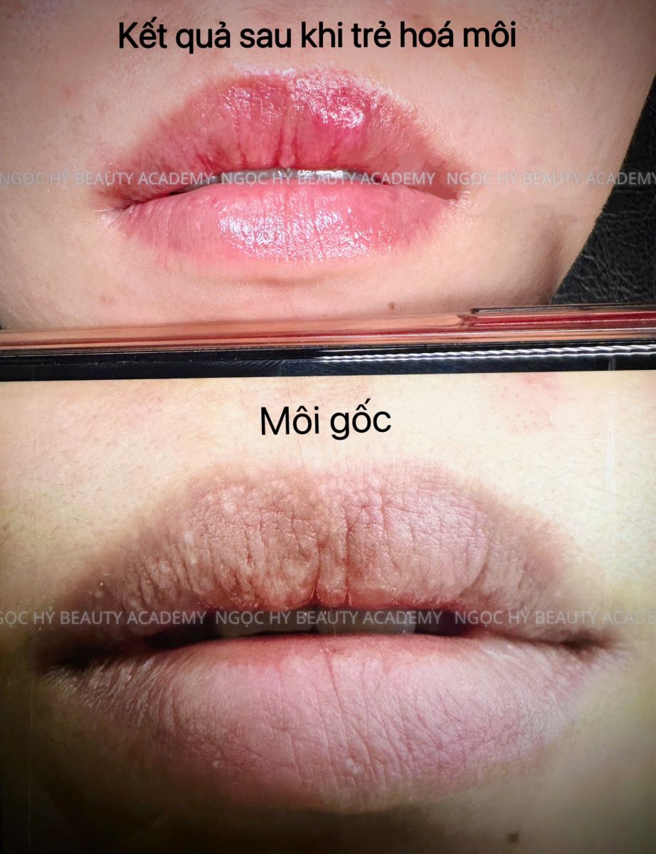 trẻ hóa môi